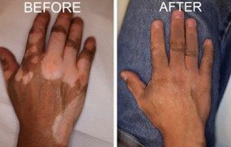 Vitiligo-1-300×207-new-1
