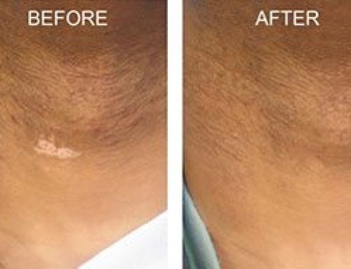 How to Choose the Best Vitiligo Treatment For You