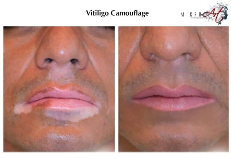 vitiligo-2