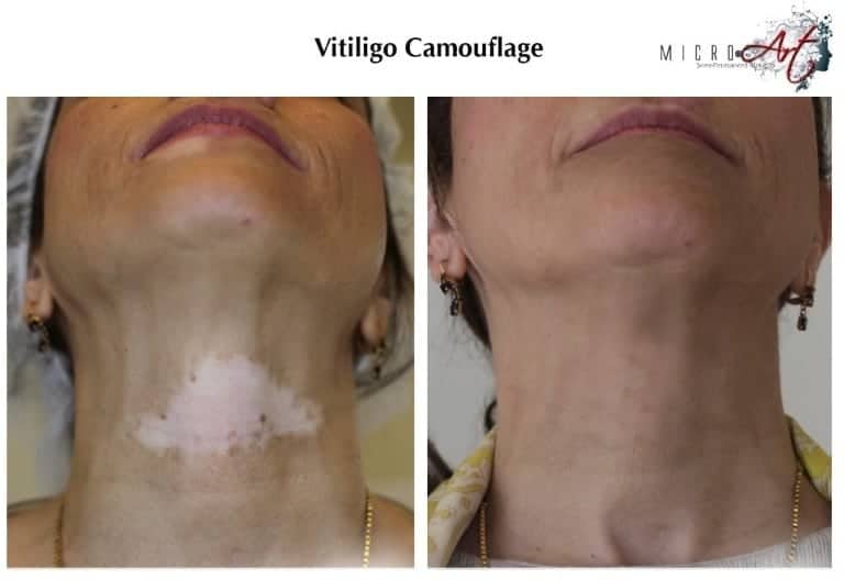 vitiligo-3
