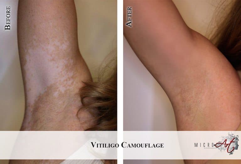 Vitiligo-2-pitt