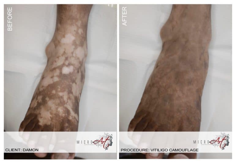 Vitiligo-Arvind-Setty_BNA-Foot-768×531