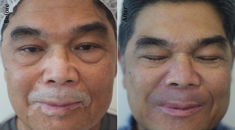 Vitiligo Treatment by MicroArt Semi Permanent Makeup