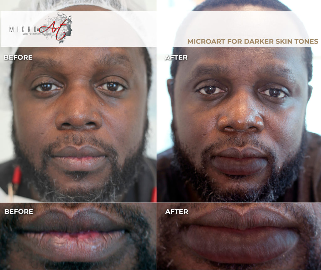Vitiligo Treatment by MicroArt Semi Permanent Makeup