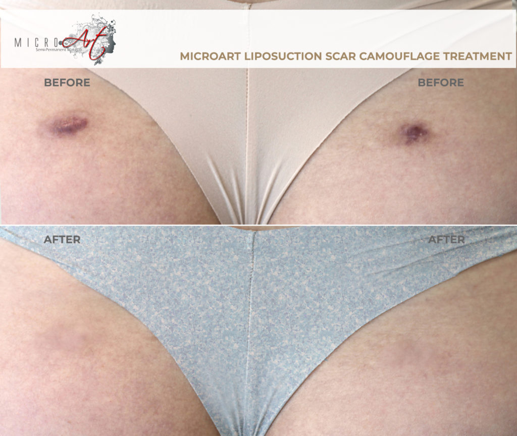 How to get rid of your Lipo Scars? Dark Scar Skin Camouflage