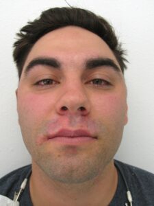 AFTER-1ST SESSION-VITILIGOONFACE