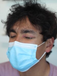 AFTER-3RDVITILIGOSESSIONONEYE-MAN