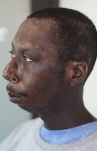 after-4th-session-vitiligo-on-face