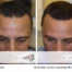 Scalp shading before-and-after result for hair loss