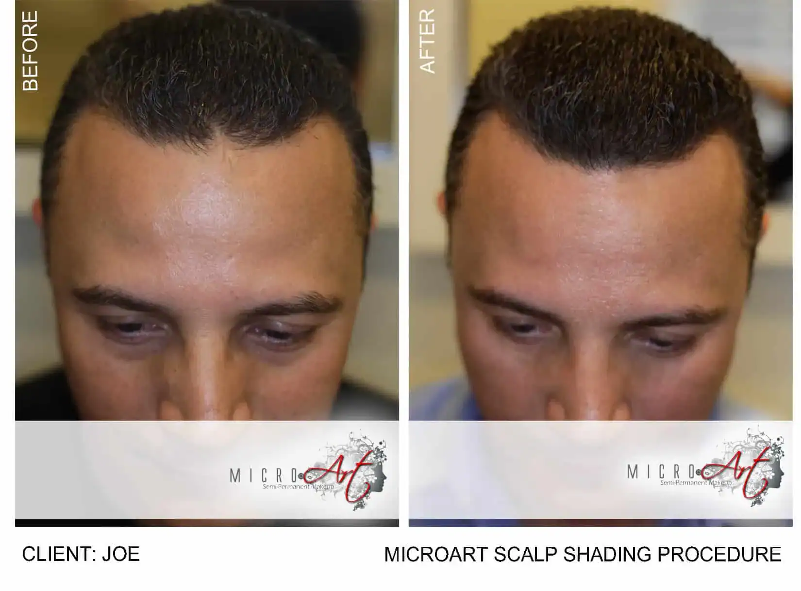 Scalp shading before-and-after result for hair loss