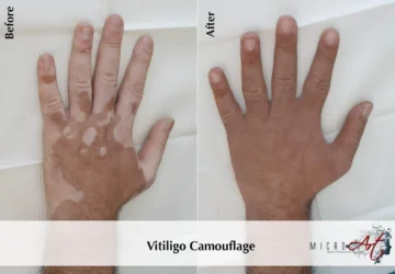 Vitiligo treatment before-and-after result on a hand