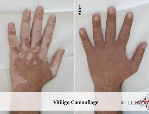 Vitiligo Treatment: What to Know Before a Consultation