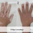Vitiligo treatment before-and-after result on a hand