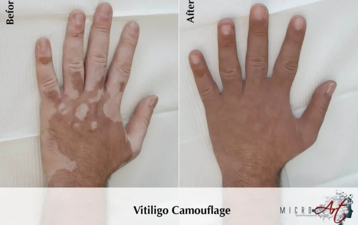 Vitiligo treatment before-and-after result on a hand
