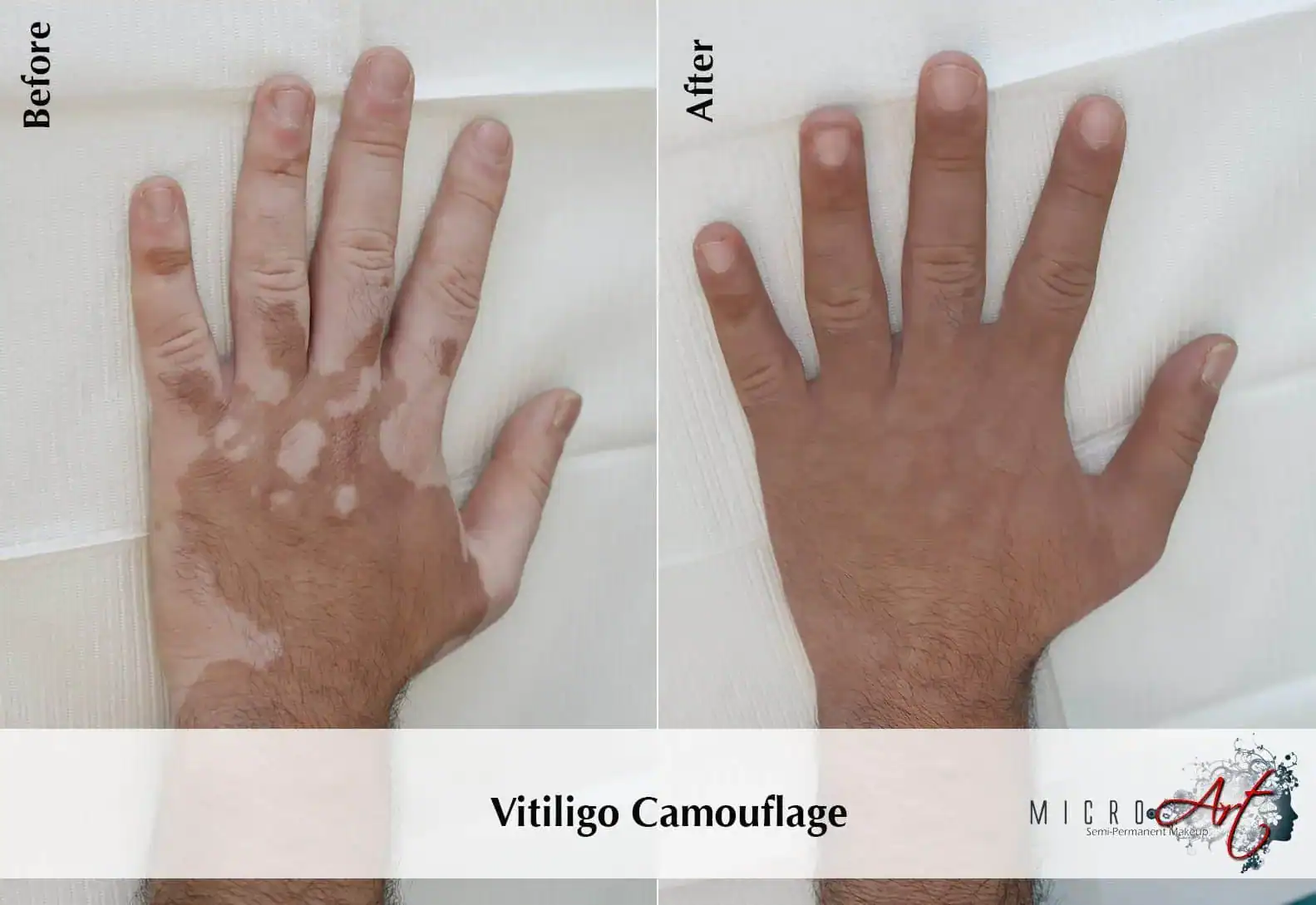 Vitiligo treatment before-and-after result on a hand