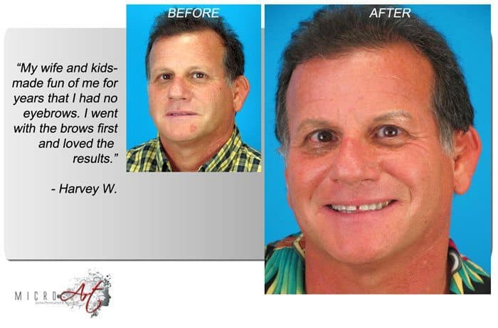 Before & After Photos of MicroArt Semi Permanent Makeup for Men