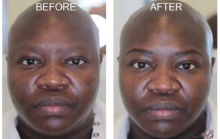 Before & After Photos of MicroArt Semi Permanent Makeup for Men