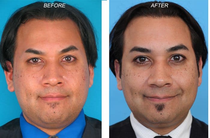Before & After Photos of MicroArt Semi Permanent Makeup for Men
