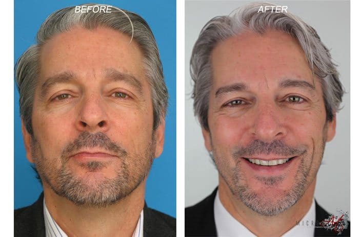 Before & After Photos of MicroArt Semi Permanent Makeup for Men