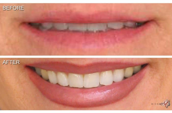 Before and After Photos of MicroArt Semi Permanent Makeup for Lips - an Alternative to Lipstick Tattoo and Permanent Lips