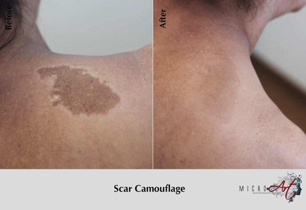 Scar Treatment By MicroArt Semi Permanent Scar Camouflage