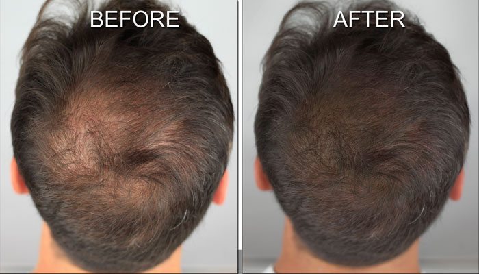 Before and After Photos of the Hair Loss Solution - MicroArt Semi Permanent Makeup Scalp Shading