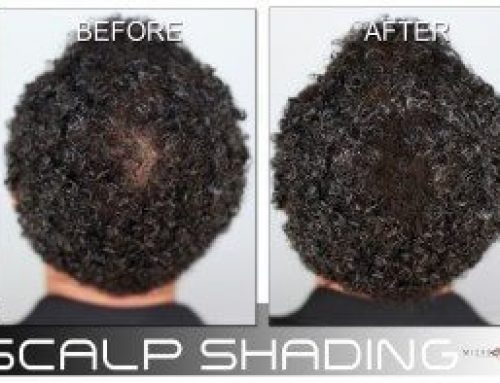 7 Tips on Coping With Hair Loss