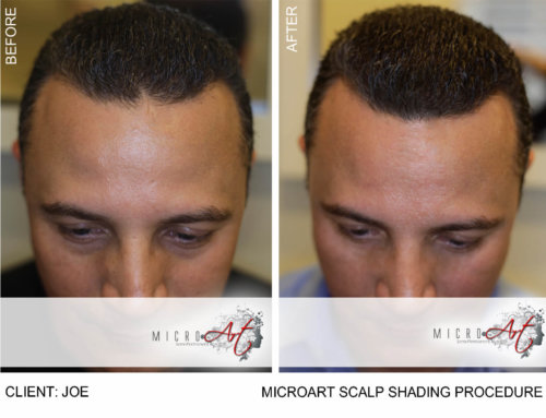 Hair Loss Solution – MicroArt™ Scalp Shading, Amazing Results!