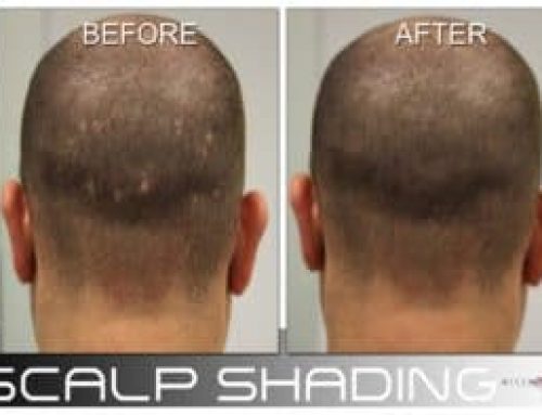 Scalp Shading Explained