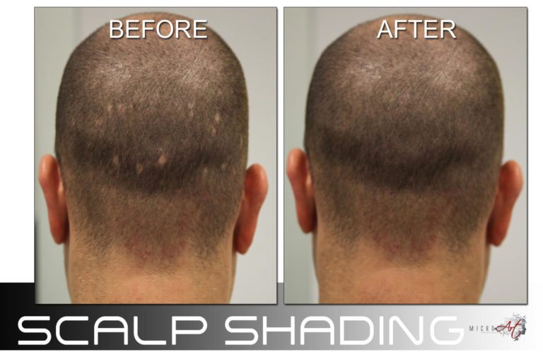 Scalp Shading for thinning hair