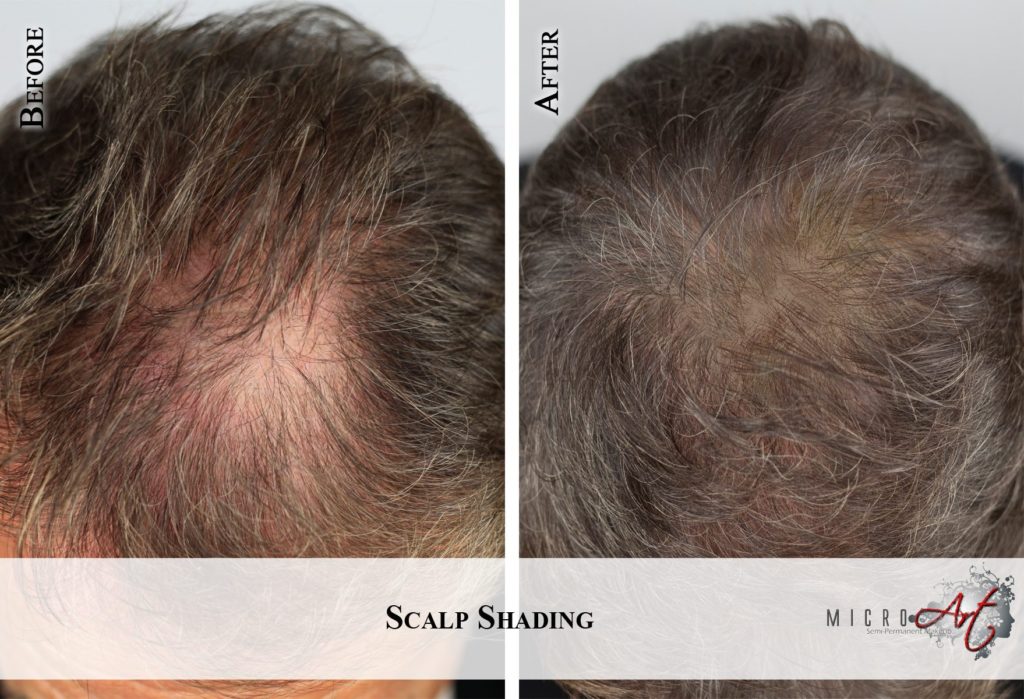 Thinning Hair Solution - MicroArt Semi Permanent Makeup Scalp Shading
