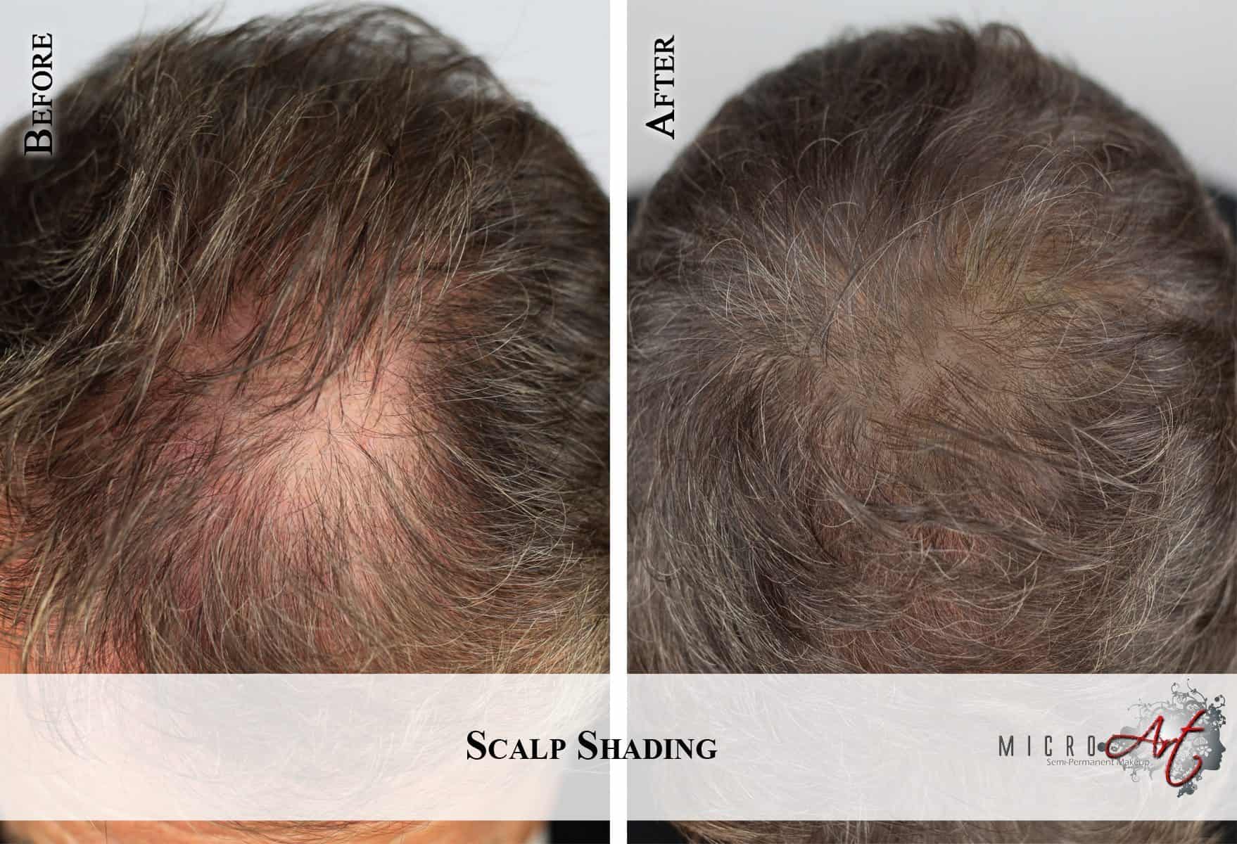 Scalp-2-Emedelo