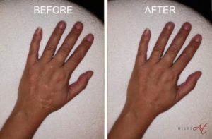 HandScarIpad-2-1024×673