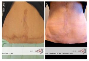 scar-before-after-lori-content