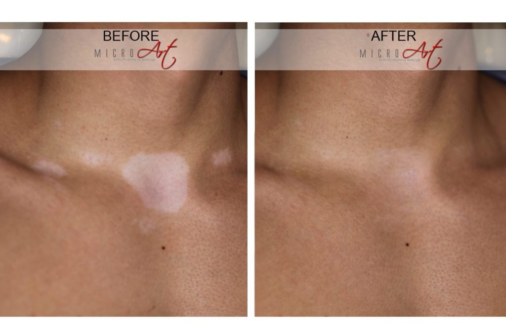 Vitiligo Treatment