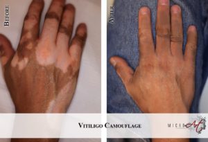 Vitiligo-1-hands