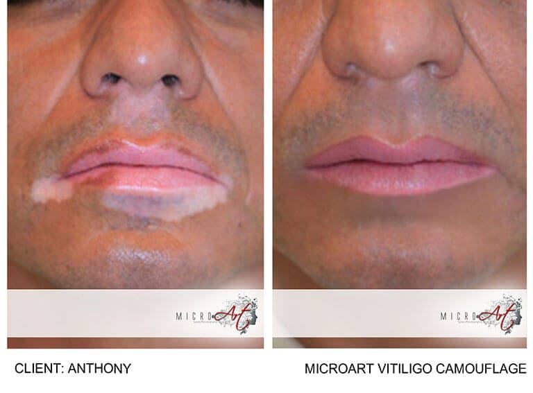 Vitiligo Treatment By MicroArt Semi Permanent Makeup
