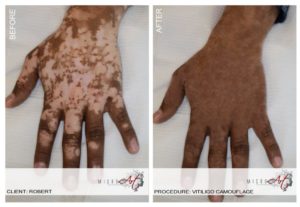 Vitiligo Treatment