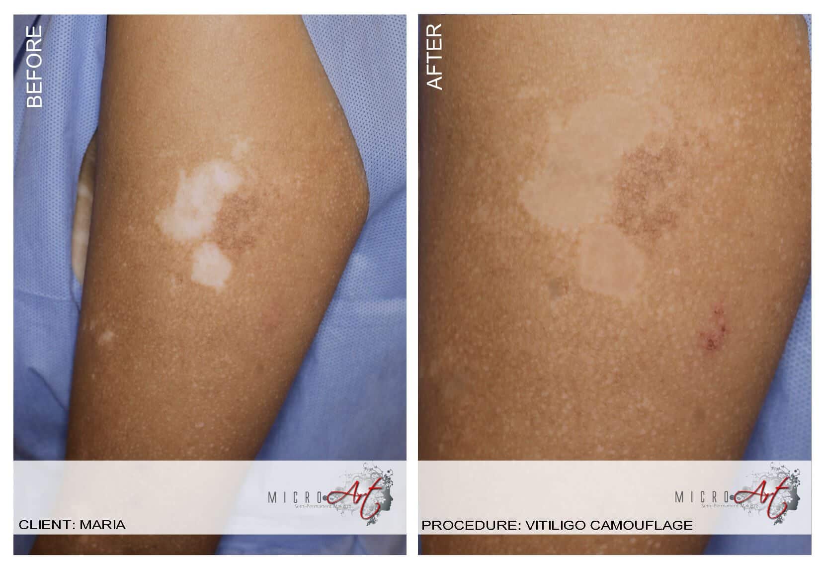 Vitiligo Treatment by MicroArt Semi Permanent Makeup
