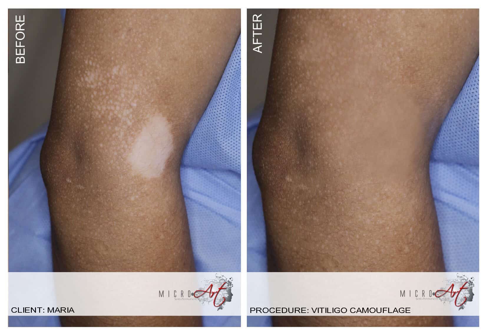 Vitiligo Treatment by MicroArt Semi Permanent Makeup