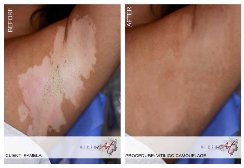 Vitiligo Treatment