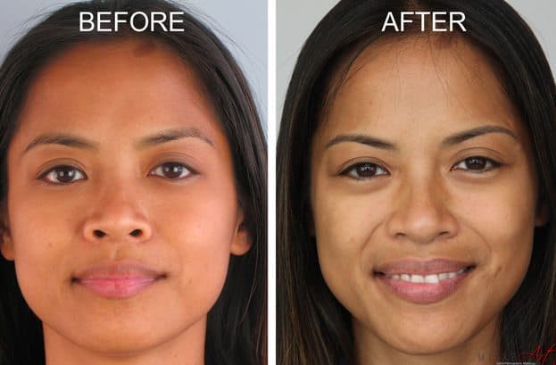 Before and After Photos of MicroArt Semi Permanent Makeup – an Alternative to Eyebrow Tattooing and Permanent Cosmetics – Venus Before & After Photos of MicroArt Semi Permanent Makeup for Eyebrows, Eyeliner & Lips - an Alternative to Eyebrow Tattooing and Permanent Cosmetics