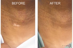 Scar Treatment by MicroArt Semi Permanent Makeup - Scar-4 Before & After Photos of Scar Treatment by MicroArt Semi Permanent Makeup